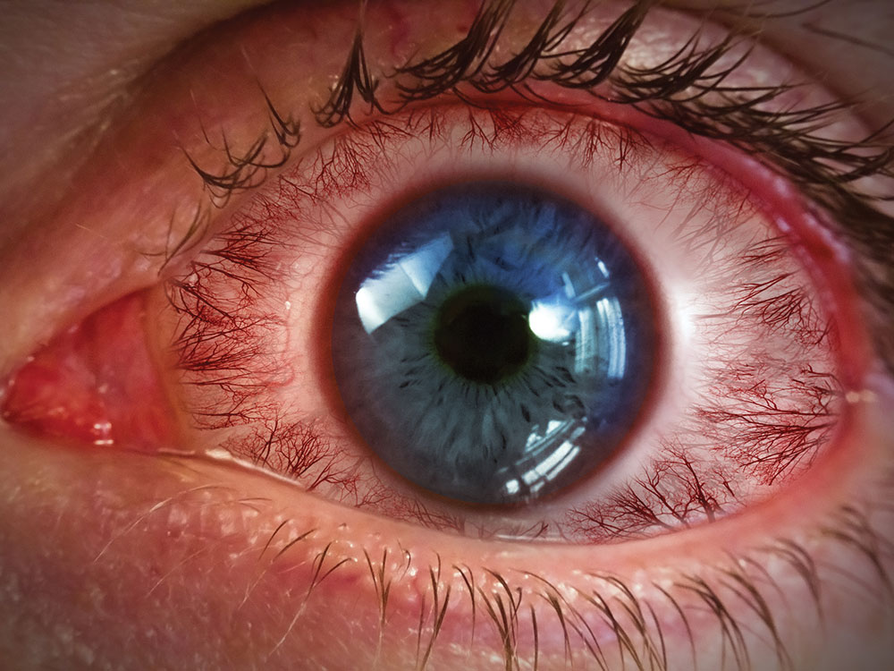 Blepharitis - red eye
